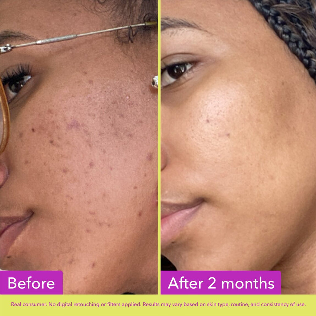 Good Molecules 10% Azelaic Acid Treatment 30ml alternative view 3.